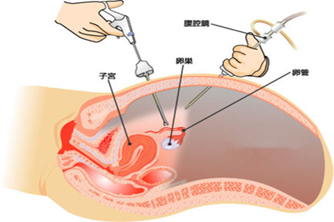 子宮切除示意